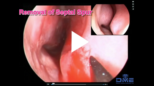 Removal of cartilaginous part of <br /> a nasal spur of the septum