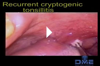 Recurrent cryptogenic tonsillitis and tonsillolith formation